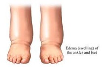 For swollen feet see Foot Solutions