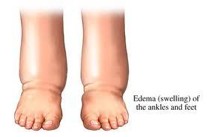 shoes for edema and swollen feet